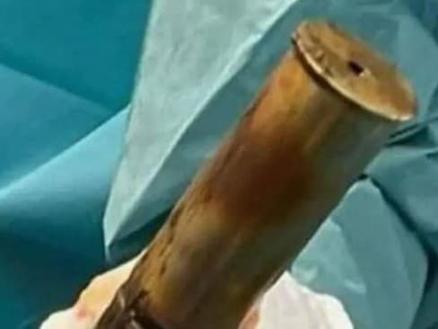 Desivá dráma v Toulouse: Mladík si do konečníka vložil delostrelecký granát