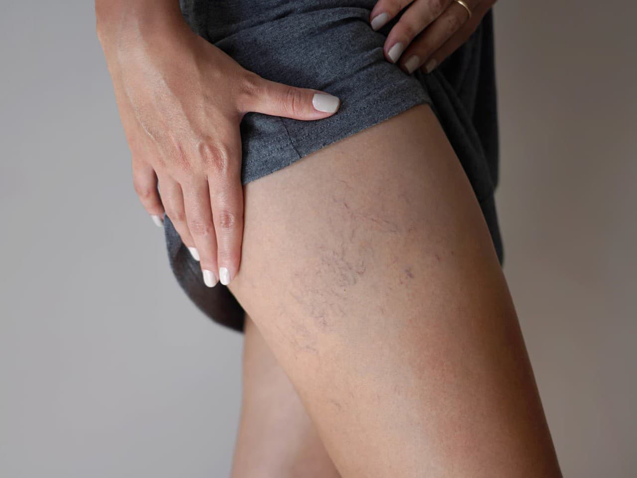 Cievne metličky na stehnách: Príčiny a riešenia