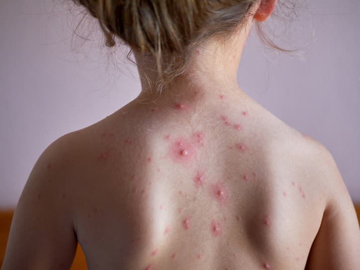 Osýpky sa vracajú: Odborníci varujú pred nákazou v Európe