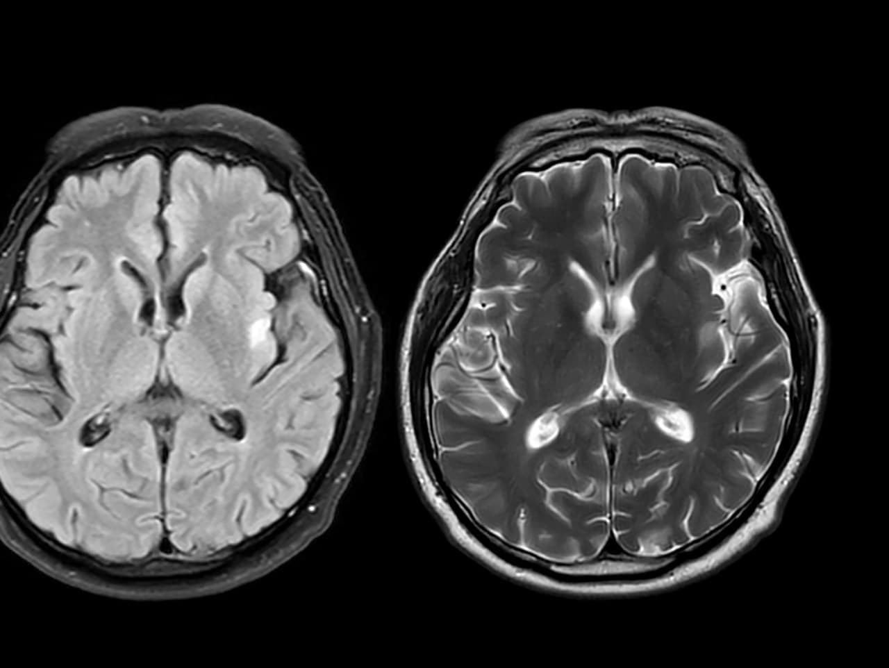 Mozog prepisuje minulosť: Ako si klameme o svojich rozhodnutiach
