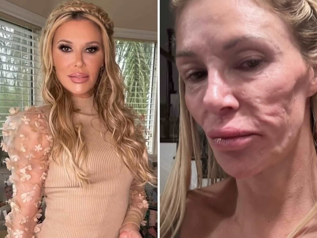 Brandi Glanville: Poškodená tvár kvôli silikónovým implantátom