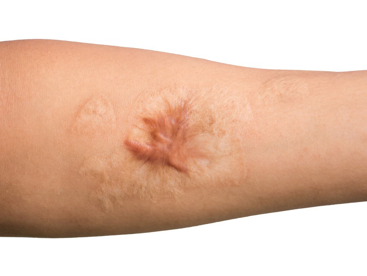 Revolúcia v hojení rán: Vedci zo Stanfordu objavili spôsob, ako eliminovať jazvy