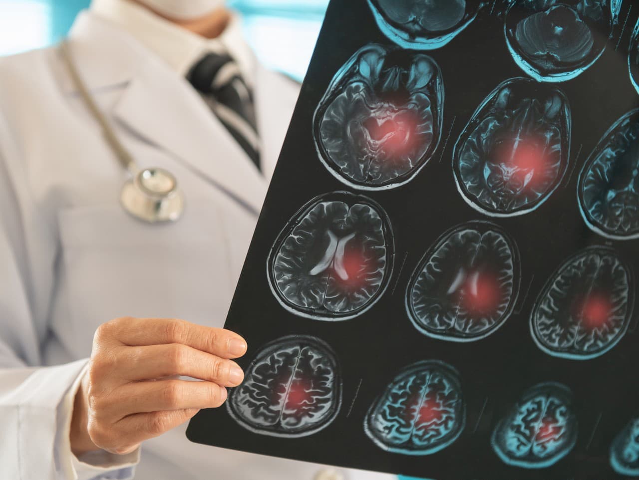 Varovné signály mozgovej príhody: Čo si všímať včas?