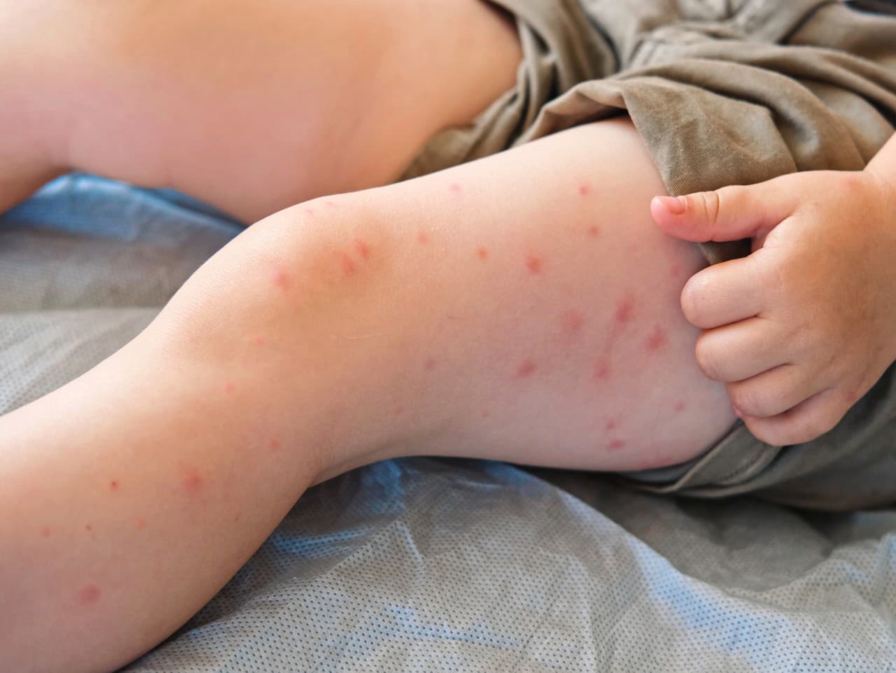 Osýpky v USA: Epidémia sa šíri, počet nakazených presiahol 600