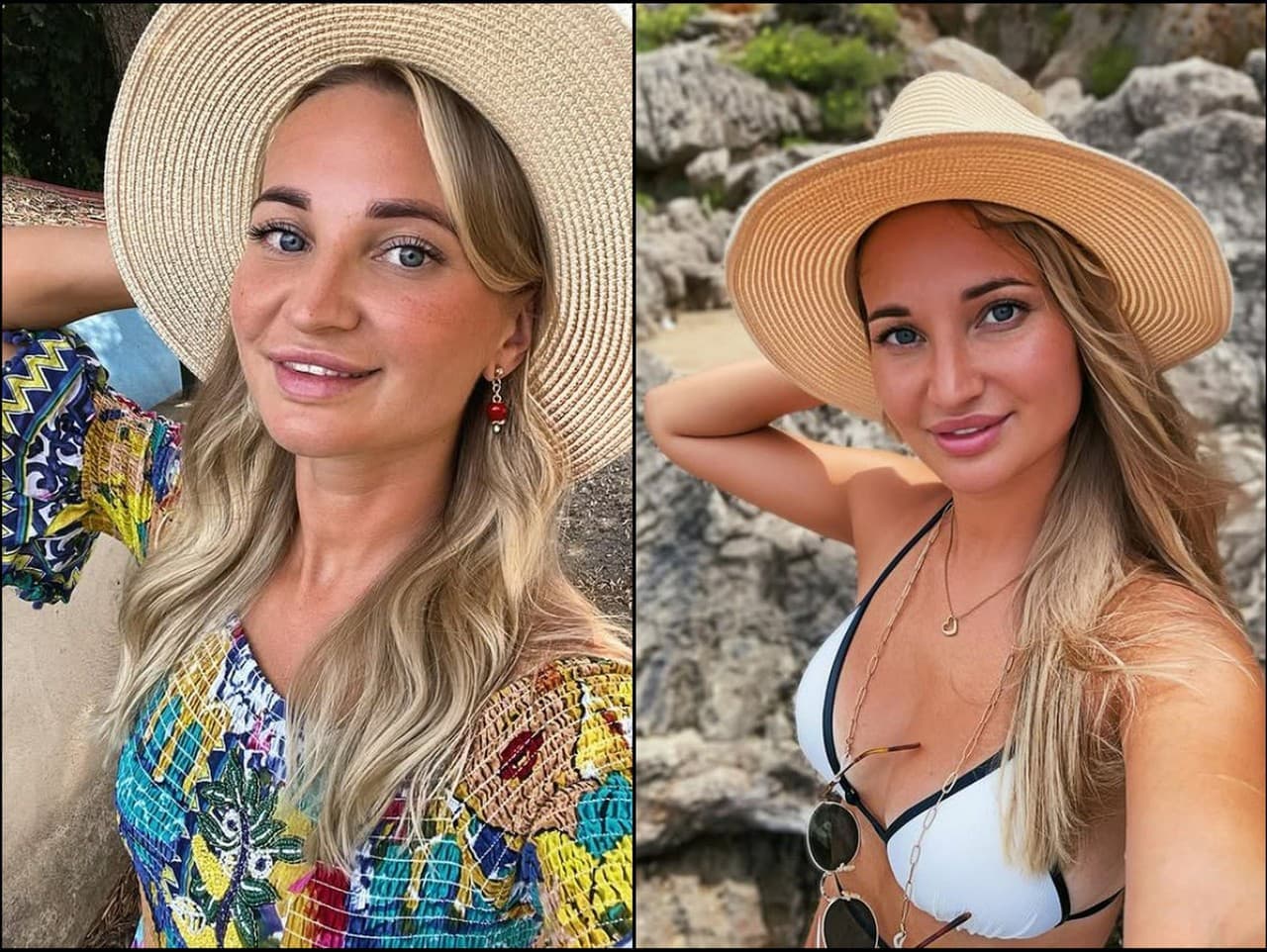 Tragédia influencerky: Po plastickej operácii zomrela v Moskve