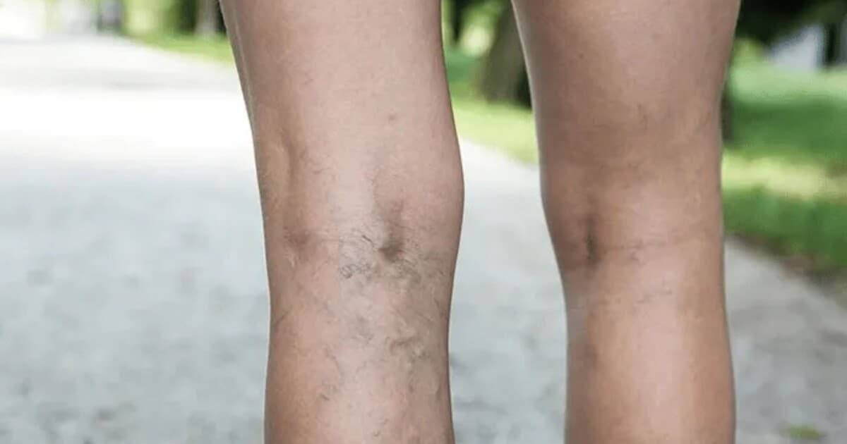 Kŕčové žily a dýchavičnosť: Varovanie pre ženy