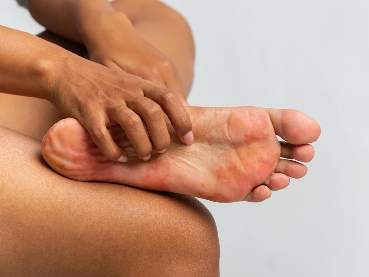 Šúpanie kože na chodidlách: Neignorujte tento problém