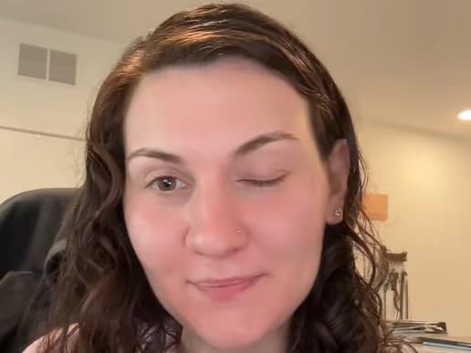 Nepodarený botox: Žena z USA sa ocitla s ochabnutým viečkom