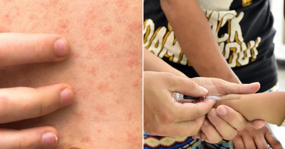 WHO varuje: Osýpky opäť ohrozujú Európu, potrebné je očkovanie