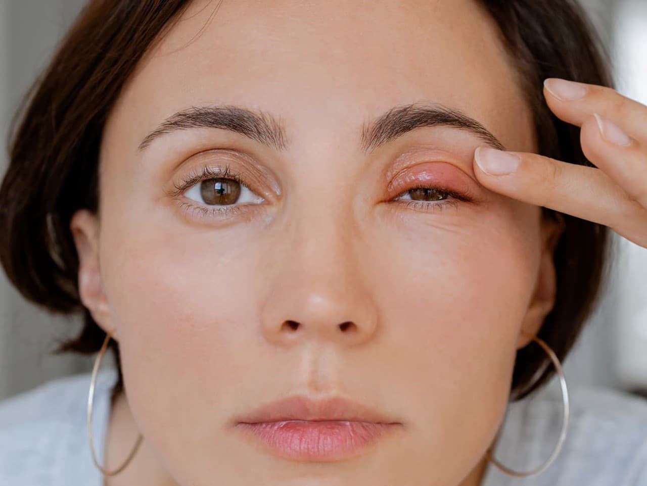 Jačmeň v oku: Zdravotný problém, ktorý si nemôžeme dovoliť ignorovať