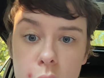 Nevinná vyrážka spôsobila vážne komplikácie: Žena skončila v nemocnici