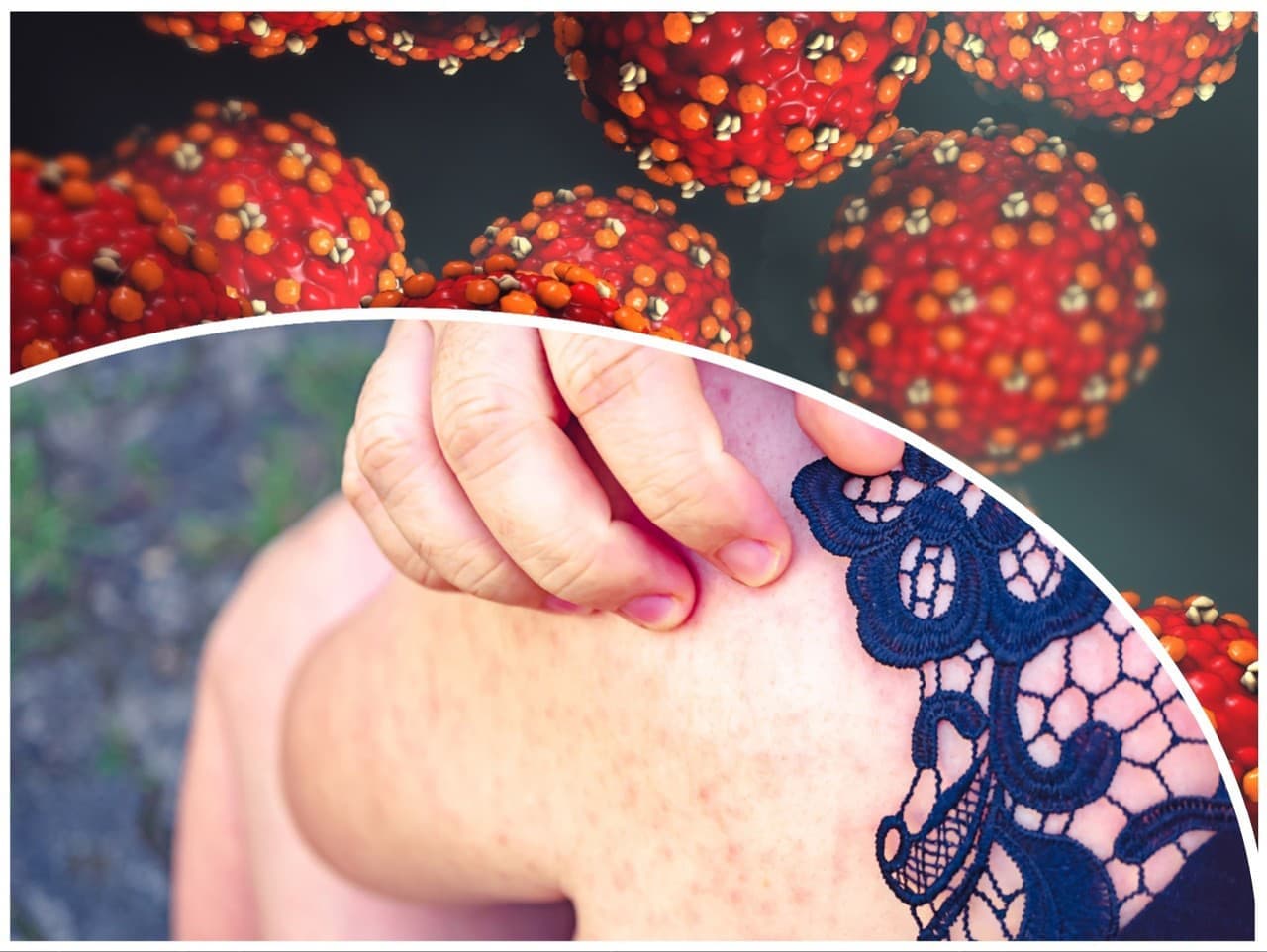 Európou sa šíria osýpky, Slovensko zatiaľ bez prípadov