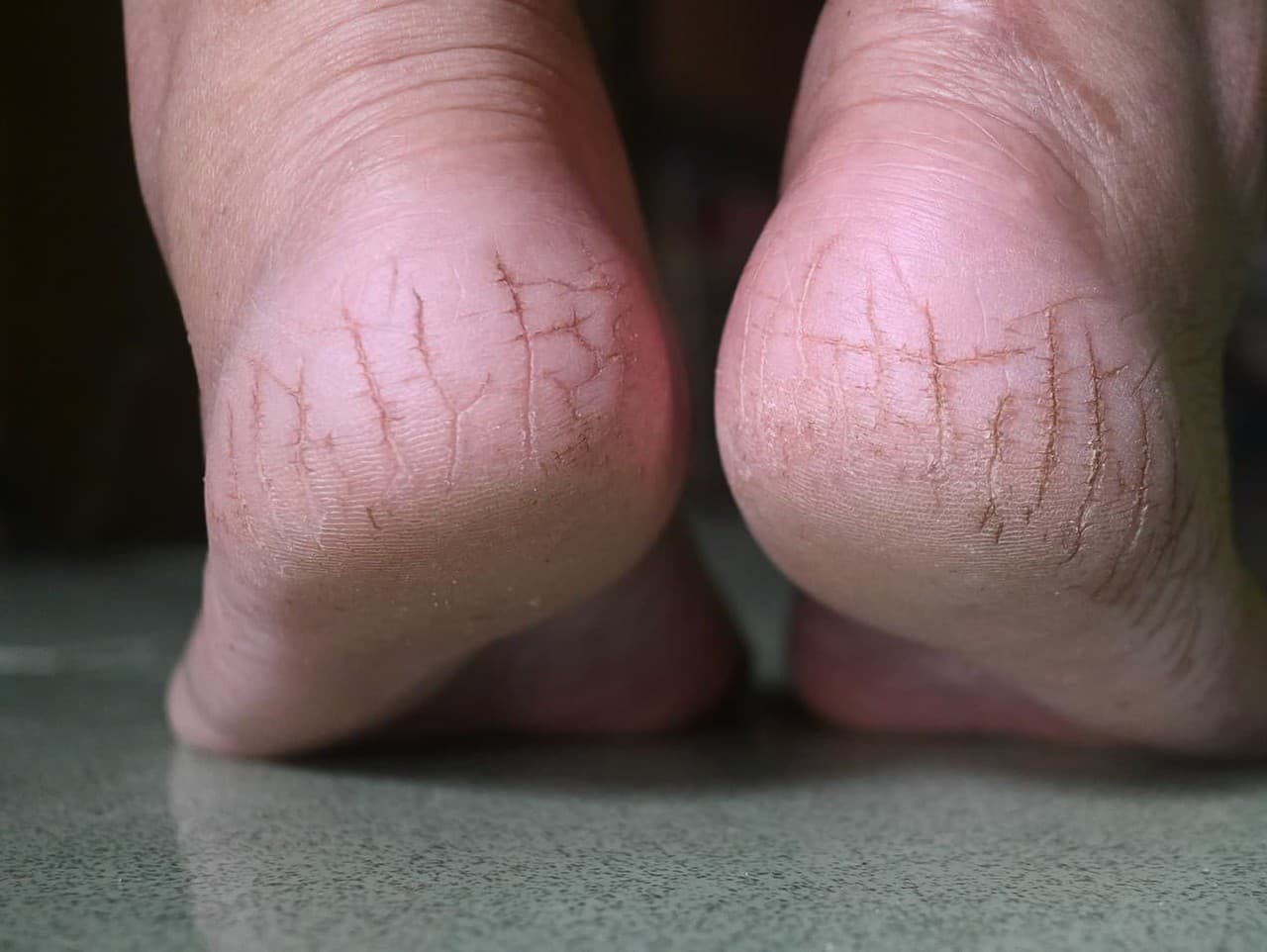 Zbavte sa popraskaných pät: Zdravotné riziká a riešenia