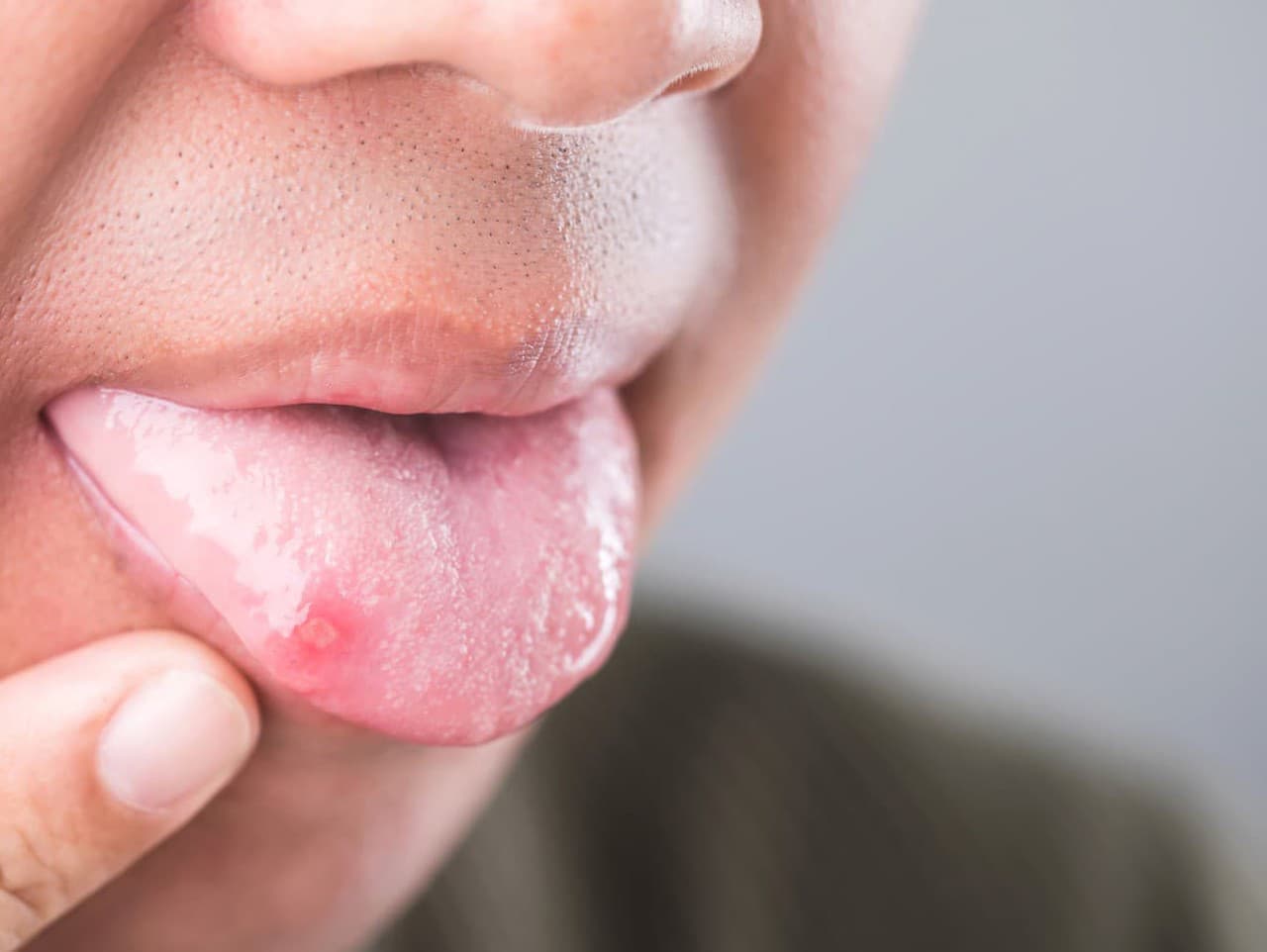 Bolestivé vyrážky na jazyku: Príčiny a liečba