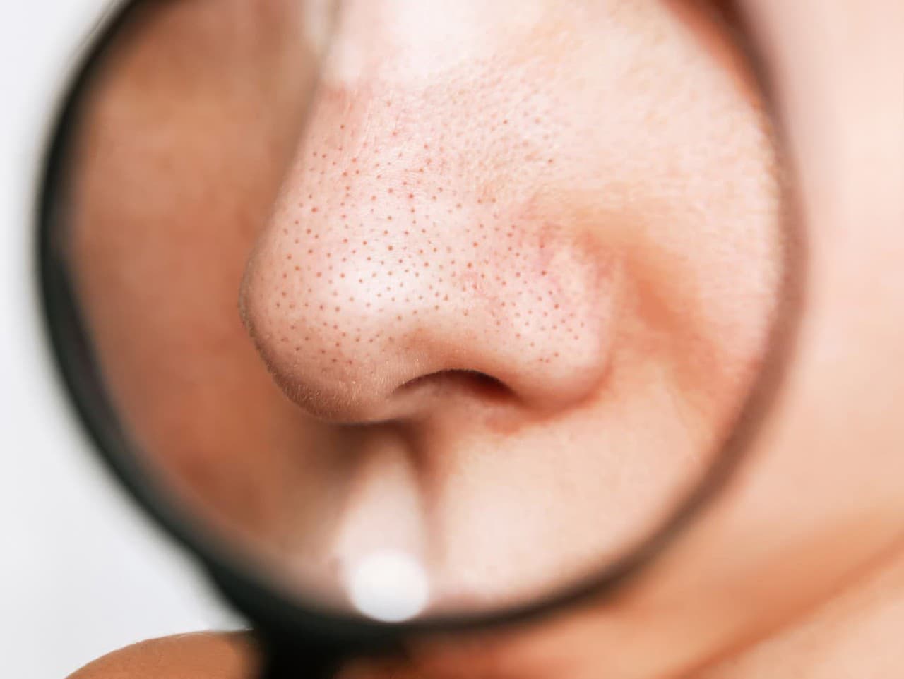 Efektívne metódy na odstránenie čiernych bodiek podľa dermatológov