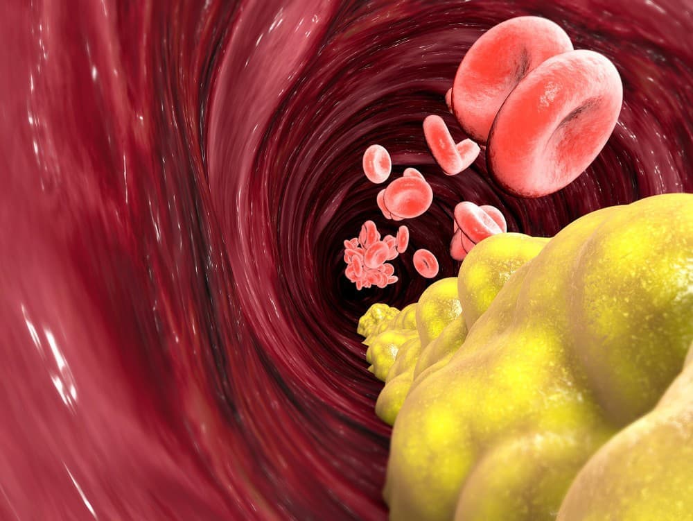 Revolúcia v liečbe cholesterolu: Genová terapia sľubuje trvalé riešenie