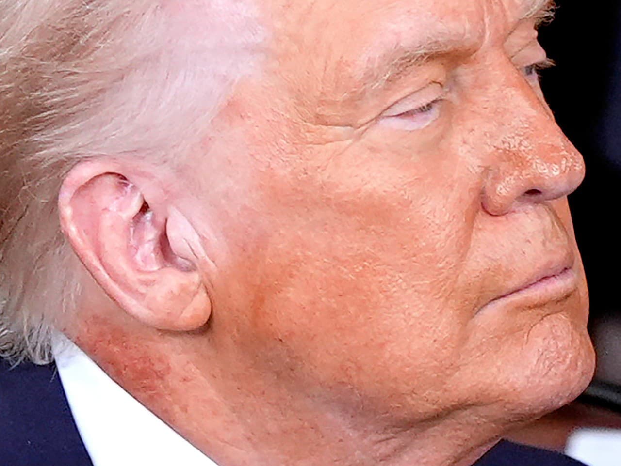 Trumpovo zdravie vyvoláva otázky: Červená škvrna a modriny na ruke