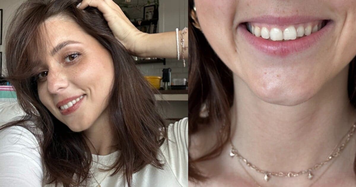 Gummy smile: Riešenie, ktoré zvyšuje sebavedomie