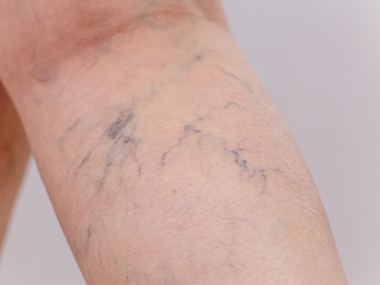 Potraviny, ktoré chránia pred hlbokou žilovou trombózou