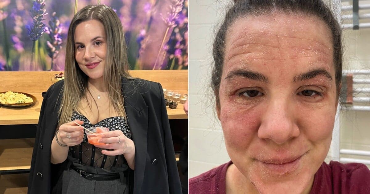 Tereza Fabiánová: Od bolesti k nádeji v boji proti ekzému