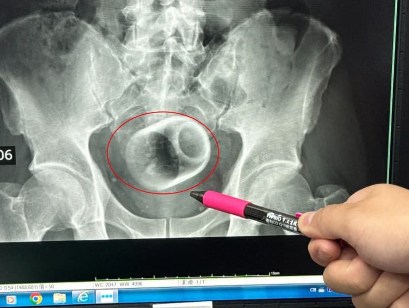 Kuriózny prípad z Taiwanu: Muž s keramickým hrnčekom v tele