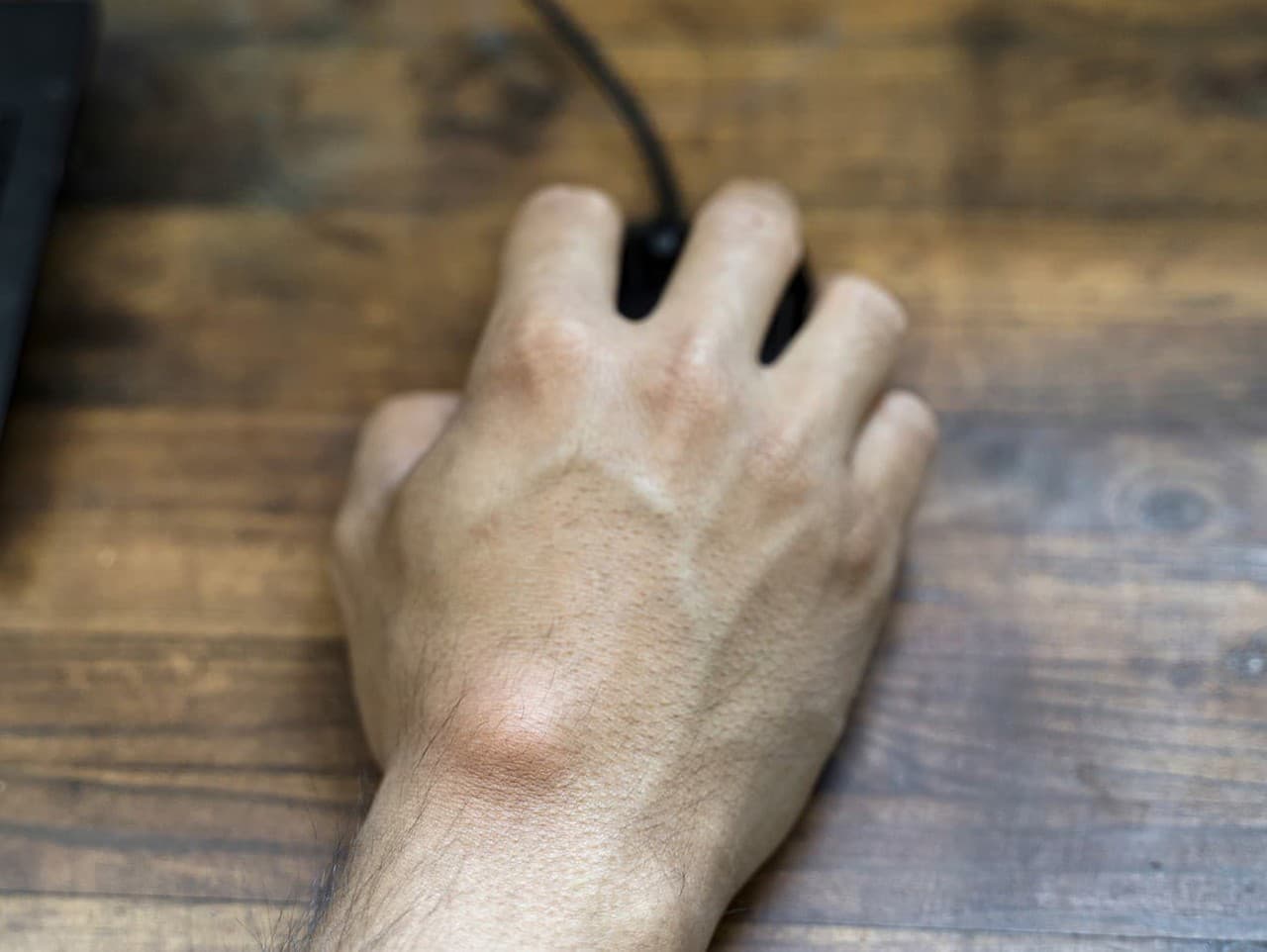 Ganglióm: Čo potrebujete vedieť o tejto nezhubnej cyste